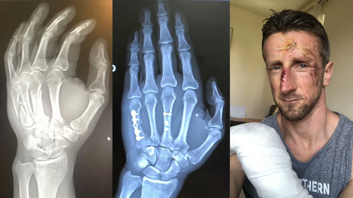 NaturalMovement's tweet photo. A Broken Hand to Doing Power Ups in 8 Weeks: Jerome's Injury Rehab Case Study - MovNat: Natural Movement Fitness https://t.co/oUtkpejfck https://t.co/KIo83QaCuE