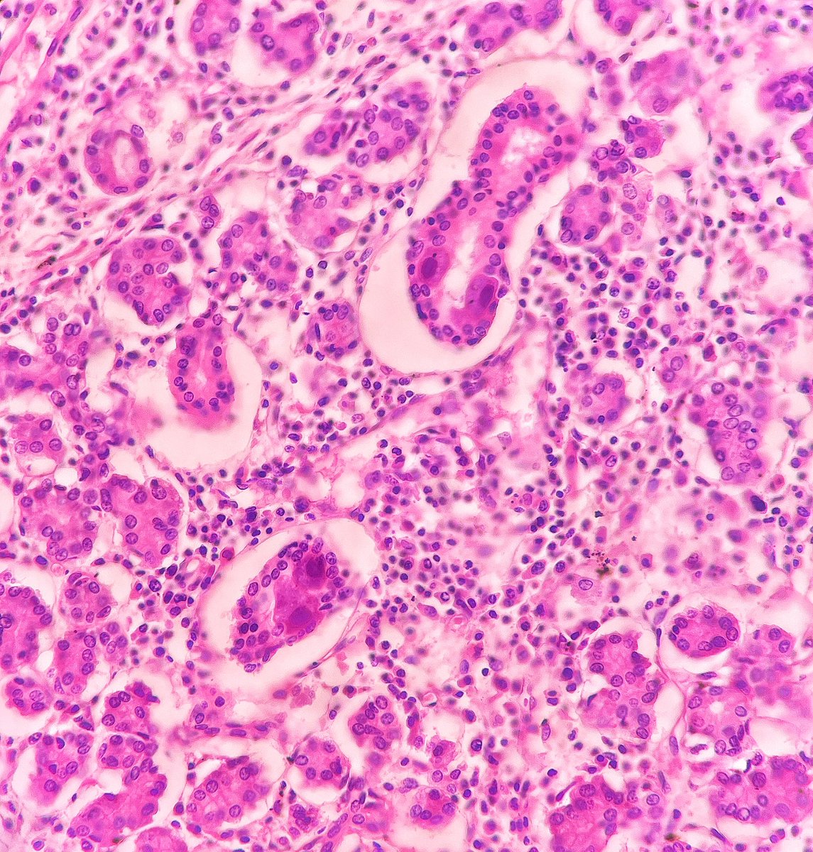 dreylulgun's tweet photo. Here I am with dear @DrBMcGinn’s one pic challenge. A cute and easy one🙌🏻
One picture - Which organ?
What is the pathology?
What is your diagnosis?
#PathTwitter #pathology #pathchallenge #forensicpathology https://t.co/7nxKypgxZA