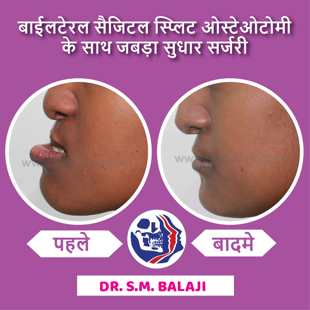 balajidental's tweet photo. बाईलटेरल सज्जितल स्प्लिट ओस्टेओटोमी के साथ जबड़ा सुधार सर्जरी
#JawCorrection #BilateralSagittalSplitOsteotomy #BSSO #smbalaji #drsmbalaji #balajidental https://t.co/az73Z56Ko0