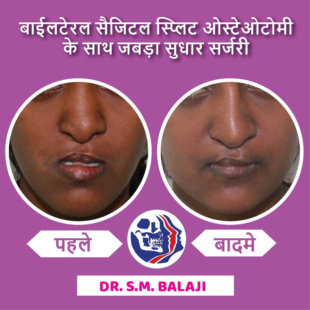 balajidental's tweet photo. बाईलटेरल सज्जितल स्प्लिट ओस्टेओटोमी के साथ जबड़ा सुधार सर्जरी
#JawCorrection #BilateralSagittalSplitOsteotomy #BSSO #smbalaji #drsmbalaji #balajidental https://t.co/az73Z56Ko0