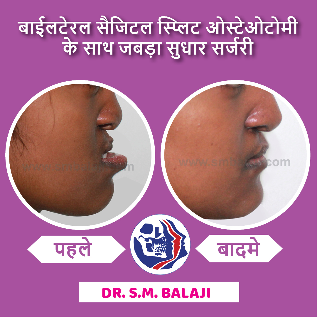balajidental's tweet photo. बाईलटेरल सज्जितल स्प्लिट ओस्टेओटोमी के साथ जबड़ा सुधार सर्जरी
#JawCorrection #BilateralSagittalSplitOsteotomy #BSSO #smbalaji #drsmbalaji #balajidental https://t.co/az73Z56Ko0