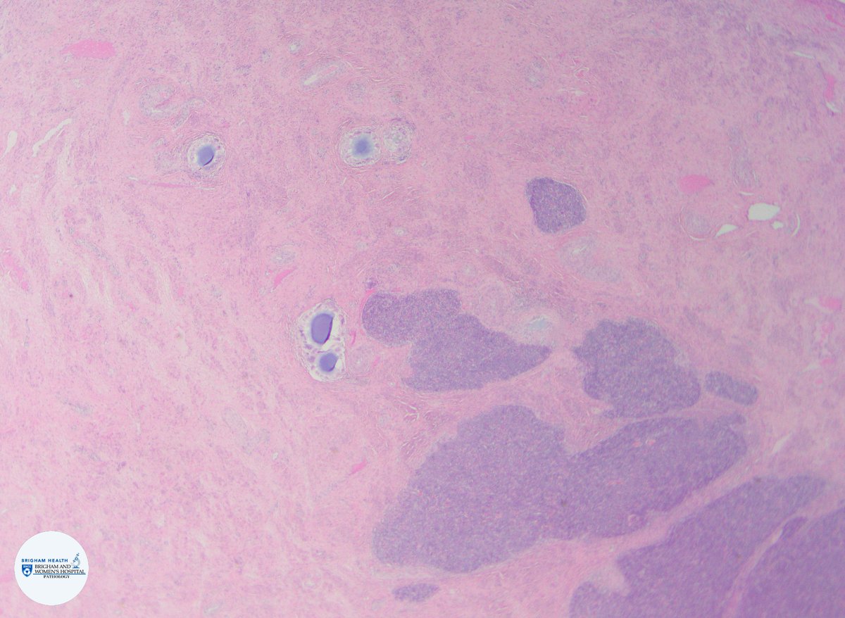 BWHPath's tweet photo. Hysterectomy in a woman with uterine mass shows intramural and polypoid mass. H&amp;E shows well-differentiated endometrial stromal cells with low mitotic activity, tongue-like myometrial infiltration, and small arterioles. What IHC would you order? #BWHPathCotW  #BWHGynPathSummer https://t.co/bDXg0sldpQ