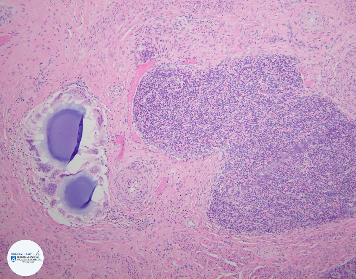 BWHPath's tweet photo. Hysterectomy in a woman with uterine mass shows intramural and polypoid mass. H&amp;E shows well-differentiated endometrial stromal cells with low mitotic activity, tongue-like myometrial infiltration, and small arterioles. What IHC would you order? #BWHPathCotW  #BWHGynPathSummer https://t.co/bDXg0sldpQ