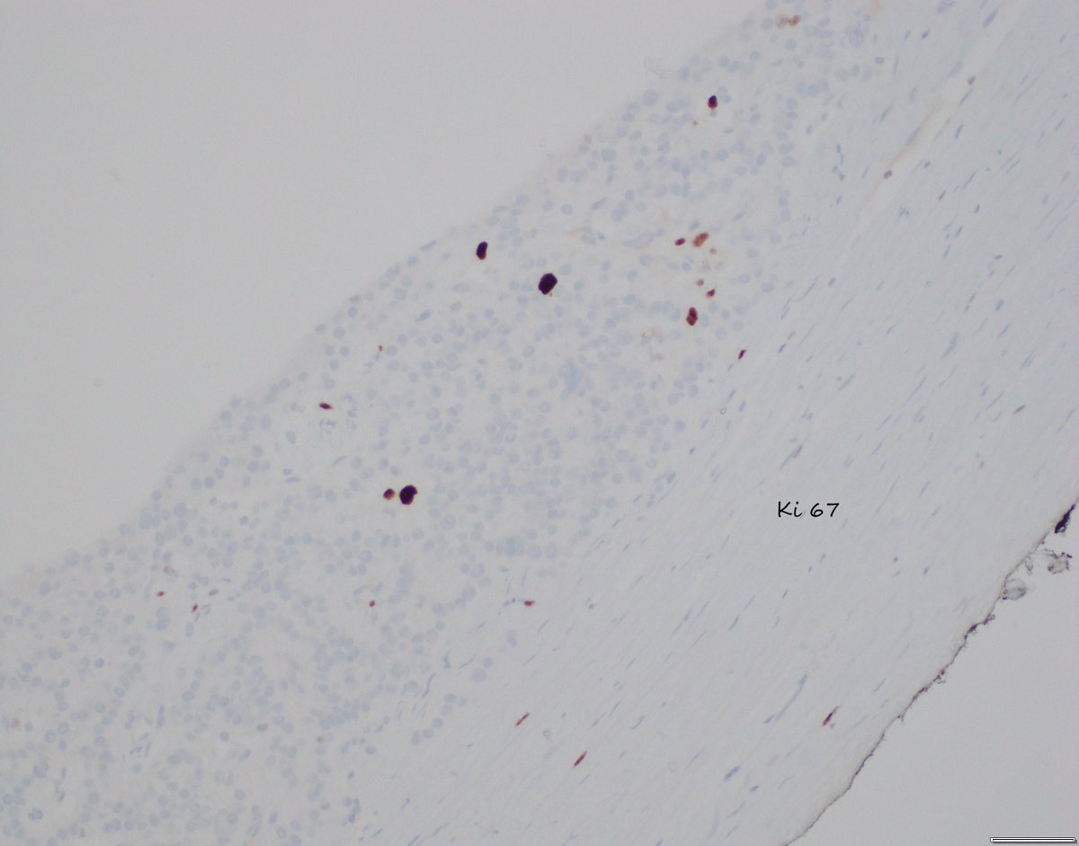 CYSTIC PANCREATIC WELL-DIFFERENTIATED NEUROENDOCRINE TUMOR
kudos to @Markie27070028 
▶️9-20% of PNETs are cystic
▶️ Body/tail > pancreatic head
▶️More favorable clinicopathologic features-single, non-functional, lower Ki-67, lower lymph node mets
▶️ Commonly mistaken for MCN