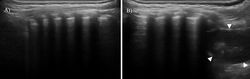 ralarcon_bme's tweet photo. Our results show that LUS cine clips can be represented as an image without significantly compromising its quality, which can help to overcome bandwidth issues and improve lung assessment of the patients in rural and remote areas. https://t.co/RgJynF1sPv