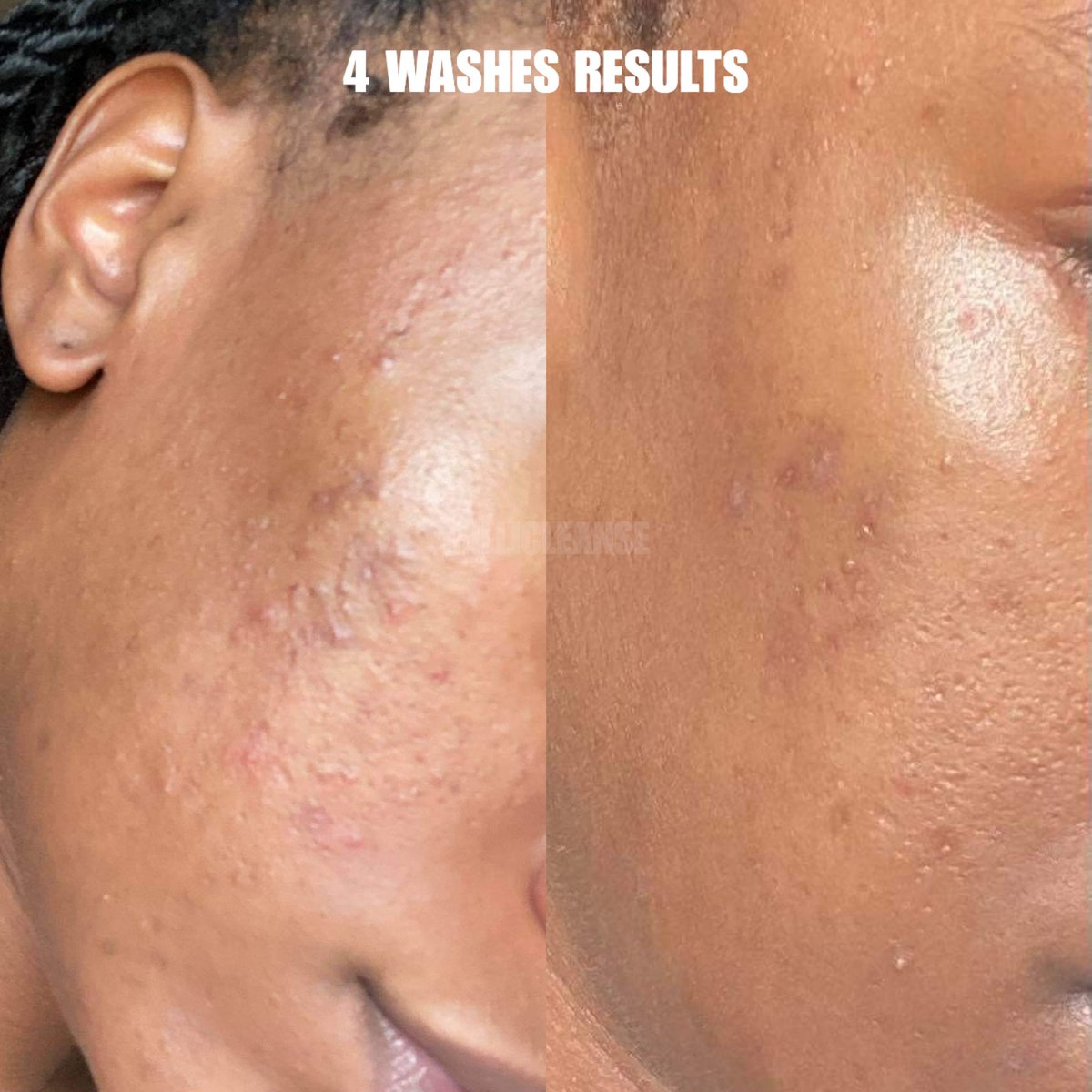 MilliCleanse's tweet photo. @xmindyobeez Experiencing troubled acne, hyperpigmentation, acne scarring, or looking for a overall skincare routine? Shop Milli Cleanse for your skin essentials, use the code “WELCOME4” for 15% off 🌿🤎 CHECK US OUT! https://t.co/20SDRNZx0H