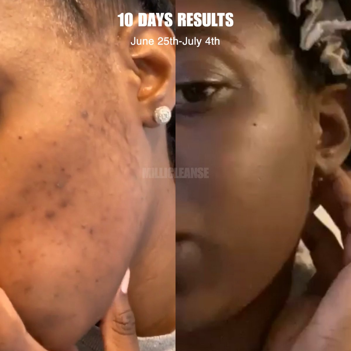MilliCleanse's tweet photo. @SMG_____ Experiencing troubled acne, hyperpigmentation, acne scarring, or looking for a overall skincare routine? Shop Milli Cleanse for your skin essentials, use the code “WELCOME4” for 15% off 🌿🤎 CHECK US OUT! https://t.co/kmIEbO2XcN