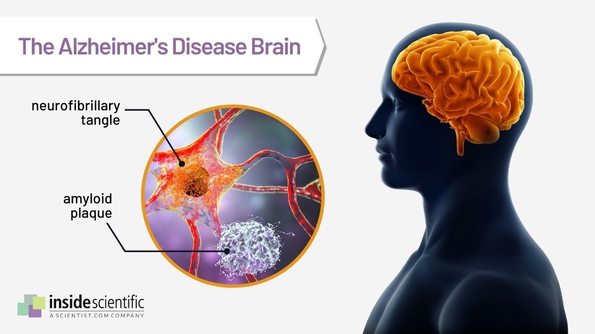 InsideSci's tweet photo. There is no cure for Alzheimer’s disease, but major breakthroughs have been made, &amp; the first amyloid plaque-targeting drug has now been approved. Read our latest article to learn more about these emerging therapies! → https://t.co/71WmsWhp8e 
#ShareScience #AlzheimersAwareness https://t.co/kL9Yit4X4J