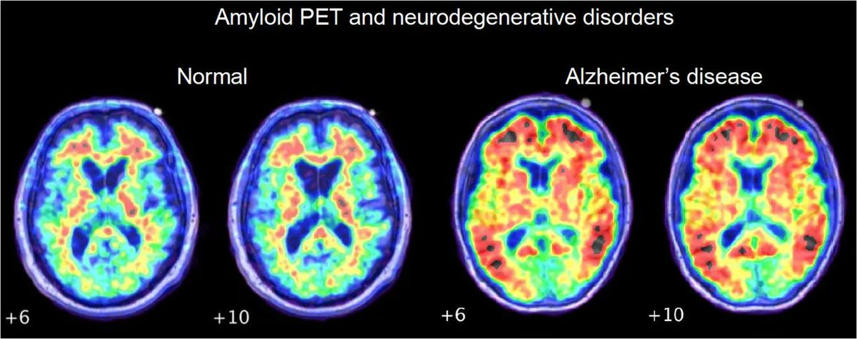 The Role of Amyloid PET in Imaging Neurodegenerative Disorders: A Review. Clinical, pathologic and imaging correlates; biomarker comparison; & review of clinical trials and clinical utility studies. bit.ly/3MVzSlv @M_Chapleau @leoiacca @RabLab_UCSF @JournalofNucMed