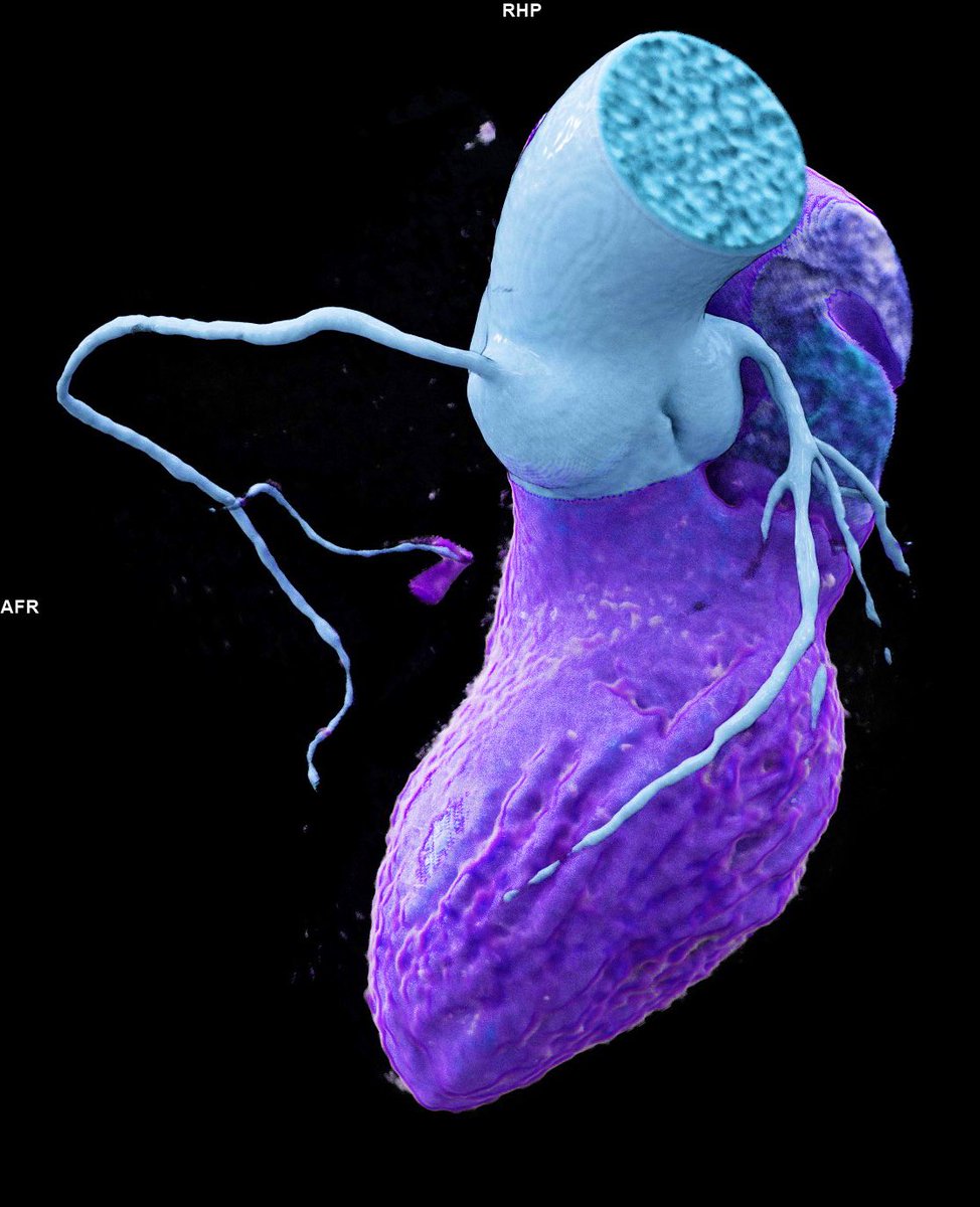 gudrunfeuchtner's tweet photo. small coronary vessel size > the fate of a sedentary lifestyle #yesCCT Coronary CTA #cardiotwitter
go get your exercise 💪🏃♀️#trailrunning #runningupforair @patagoniaeurope https://t.co/aXwc2y87Gy