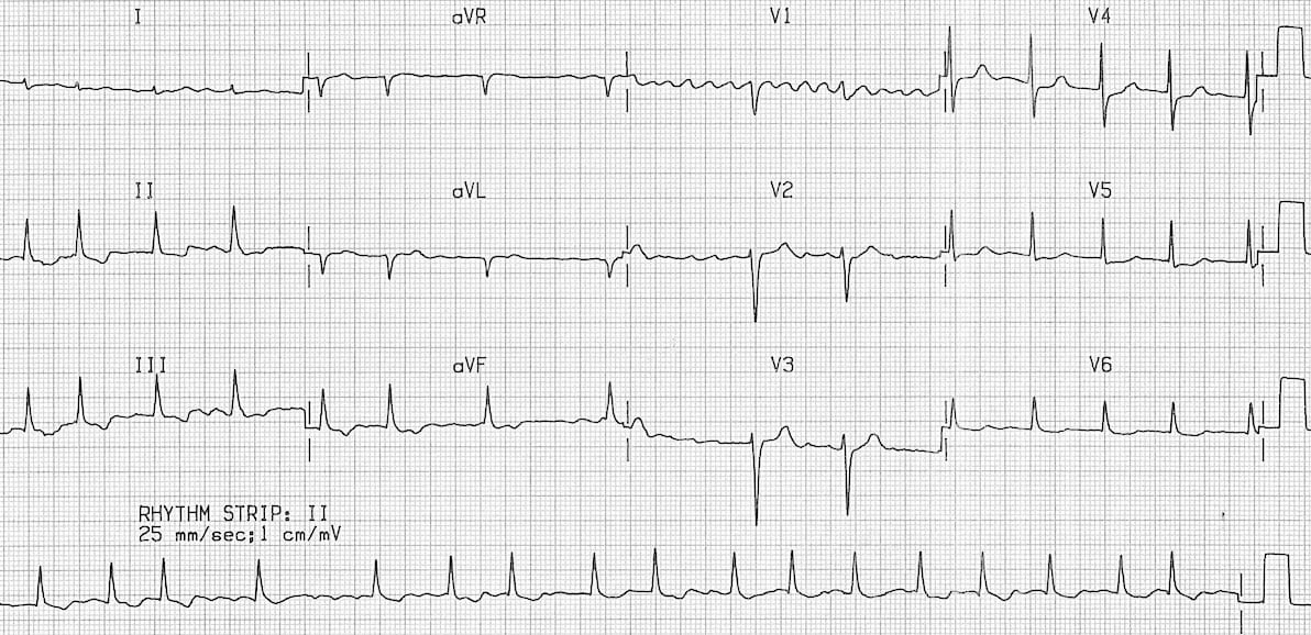 Welcome to #ECG of the week where we examine strips commonly interpreted by EM physicians. Comment below what rhythm this ECG shows!

#medicalschool #medicine #med #medicalstudent #emergencymedicine #emergency #embound #emergencym #doctor #ECG #EKG #Trivia
