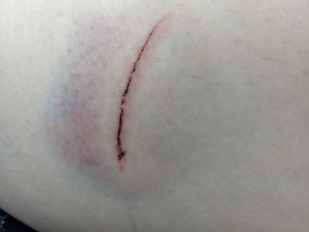 Probably should have put arnica on my bike bite. Yum #blackandblue