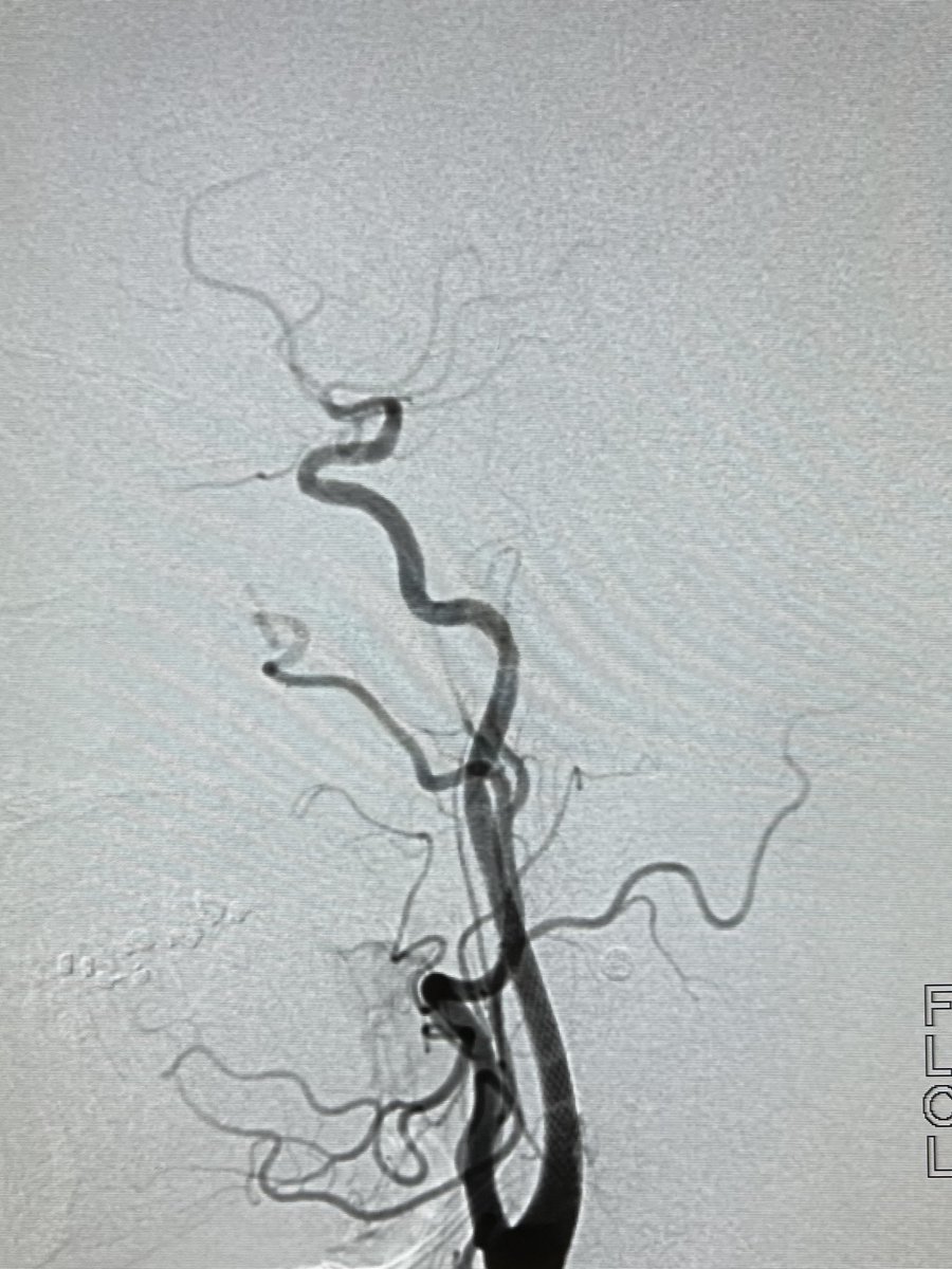 Stenting Carotid dissection with Radial Approach. #RadialFirst #Radialforneuro
