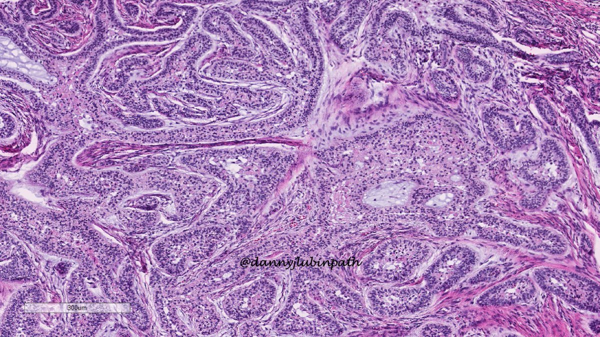 Ameloblastoma of mandible- gross/histo correlation

#entpath #headandneckpath #oralpath