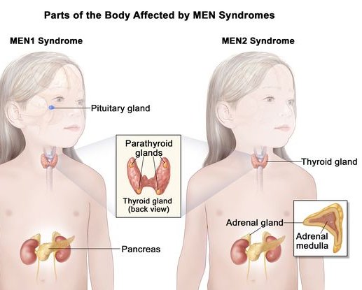 endocrinology20's tweet photo. Multiple endocrine neoplasia, group of disorders that affect the endocrine system. Multiple endocrine neoplasia typically involves tumors. These growths can be noncancerous or cancerous.
Visit our webpage: https://t.co/g2wNH3dfqV
#MEN #hormonaldisorder #enocrinetumors https://t.co/I4tnLcHuuy