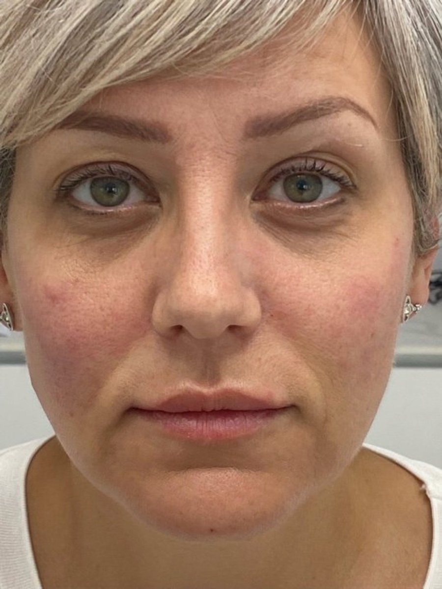 From this to that in 30 mins! 💉💉 Its not about how much we use, but where we place it! 
#fillers #facelift #cheekfiller #aesthetics .#hull #yorkshire #botox #skin .#youthful #agereversal #skincare #lesleywilks