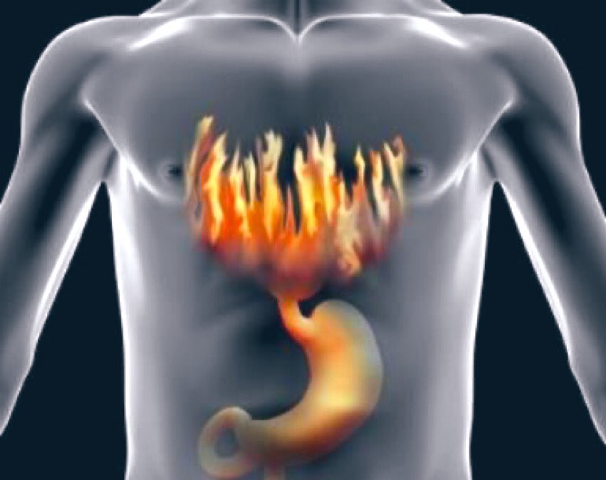 🛑تجيك حموضة وحرقان وأحياناً كحه وشرقة وقت النوم والطبيب أخبرك أن هذا إرتجاع المريء وخايف من أدوية الحموضة

هذا السرد لك👇🏻