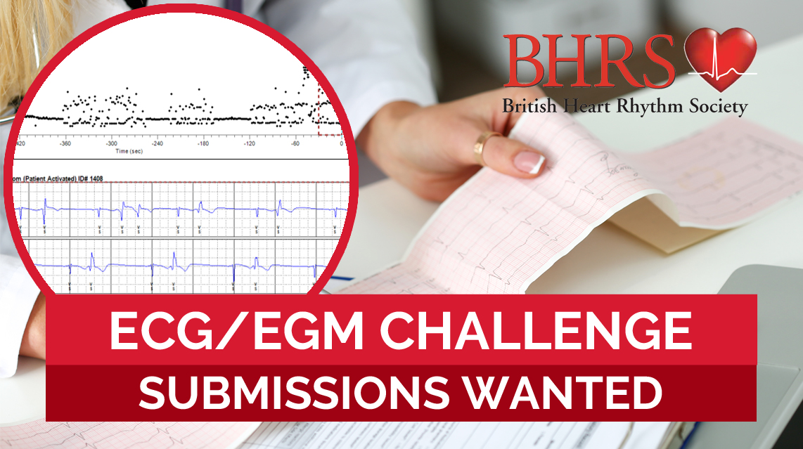 If you have an interesting case, ECG or EGM please consider submitting a report to BHRS. It’s a great opportunity to show CPD &amp; share experiences for others to learn from. For examples of other challenges published, &amp; details of how to submit yours, visit: bhrs.com/ecg-egm-challe…