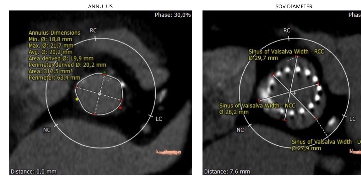 82y patient with severe AS treated with TAVI (ACURATE S 23mm) implanted in the supra-annular position with severe residual regurgitation... #Complex22 #UnicCHUC #CardioCHUC