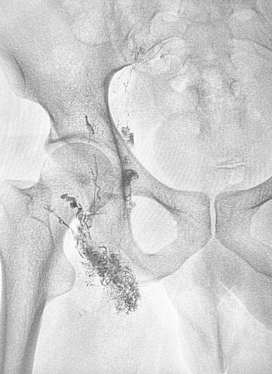 Dr Ajit Yadav (@drajityadav) on Twitter photo *Lymphatic Intervention*
Case of femoral artery repair lymphocele
500 ml Lymph/ day
Antegrade Lymph node Glue Embolization
Post Embolization Drain out put Nil
<a href="/itkinmax/">Maxim Itkin MD</a>
<a href="/drgauravgangwni/">Dr. Gaurav Gangwani (Interventional Radiologist)</a> <a href="/No_cut_surgery/">IIR IRad indore</a> <a href="/ISVIRIndia/">ISVIR India</a> <a href="/thegestgroup/">GEST -Global Embolization Symposium & Technologies</a> *Lymphatic Intervention*
Case of femoral artery repair lymphocele
500 ml Lymph/ day
Antegrade Lymph node Glue Embolization
Post Embolization Drain out put Nil
<a href="/itkinmax/">Maxim Itkin MD</a>
<a href="/drgauravgangwni/">Dr. Gaurav Gangwani (Interventional Radiologist)</a> <a href="/No_cut_surgery/">IIR IRad indore</a> <a href="/ISVIRIndia/">ISVIR India</a> <a href="/thegestgroup/">GEST -Global Embolization Symposium & Technologies</a>