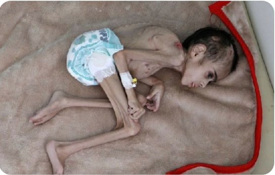 مُتّ بسلام يا من رأيت الدنيا ولكن لم ترى فيها العدالة؛ سلام عليك يوم ولدت ويوم تموت ويوم تبعث حيا 
#انقذوا_اطفال_اليمن