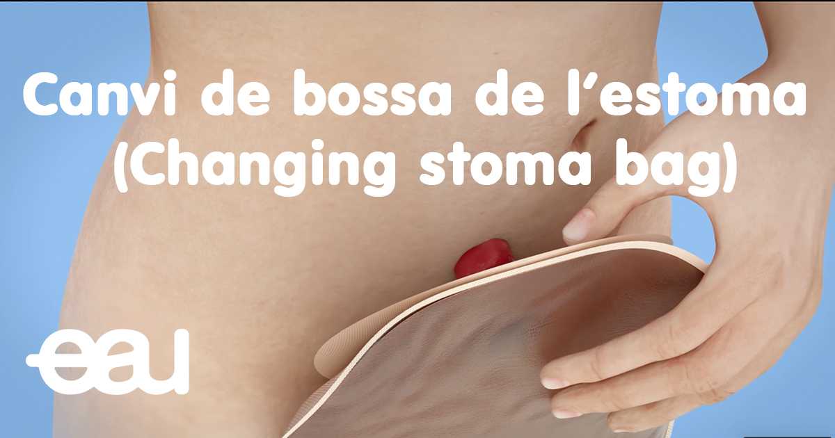 EauPatient's tweet photo. New EAU Patient Information Videos in Catalan available. Thanks to @MariaJRibal @MontserratArzoz @LaliSabartes @scurologia. A selection:
Stoma bag: https://t.co/ZWCTcZrp4J
JJ: https://t.co/OV90oPxzhQ
Cystoscopy: https://t.co/8WvPVkgyd8
Cystectomy: https://t.co/v4QhiAyb8k https://t.co/NEn1O66VqJ