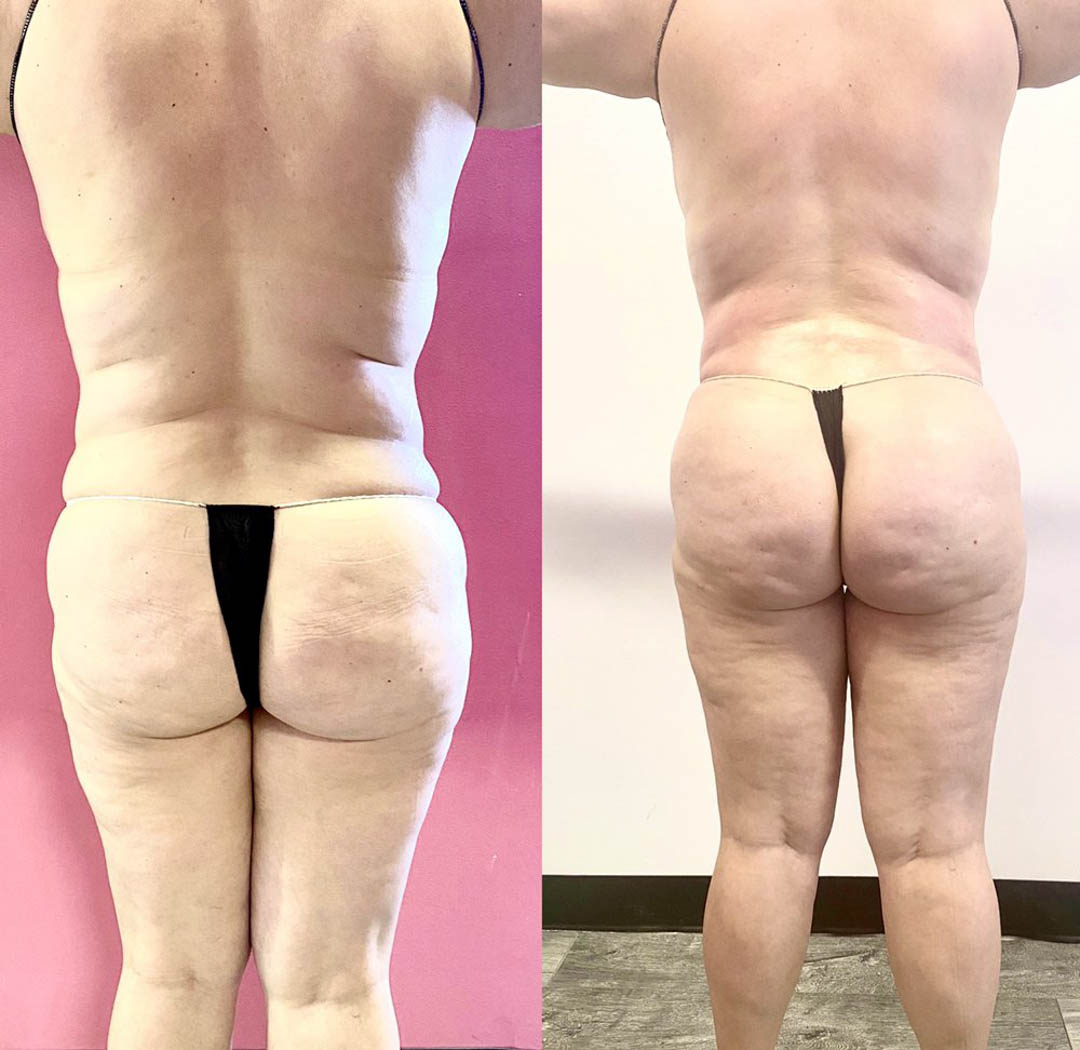 SnatchingBLA's tweet photo. Reach out to us if you're in the Hermosa Beach area and are in need of Butt Lift services. SnatchingBodiesLA is looking forward to assisting you! #ButtLift https://t.co/zY59mLMgyR https://t.co/SW4Lb7bKoM