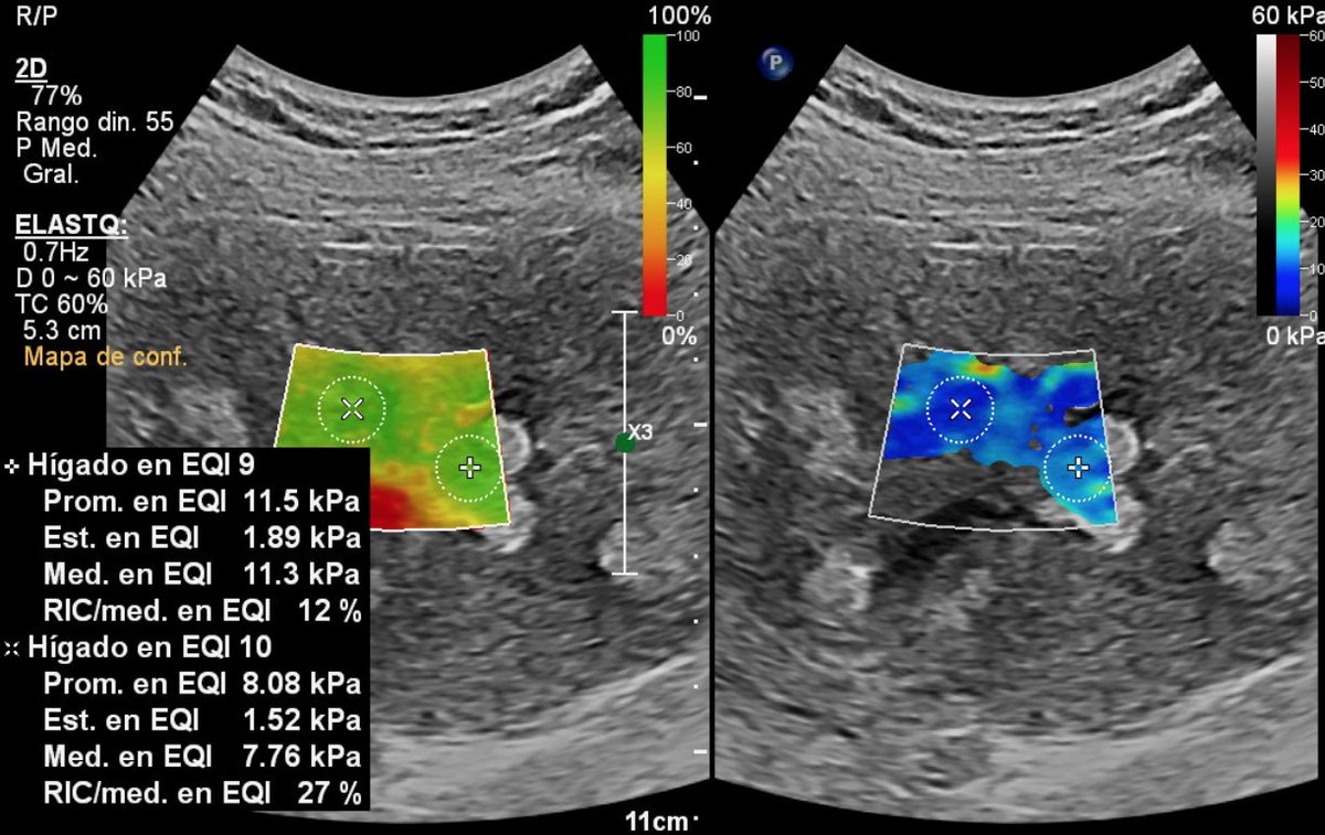 RXabdopel_HCUCH's tweet photo. Se realiza Elastografía hepática ARFI con equipo Phillips Epic 7 ElastQ con énfasis en zonas con aumento de ecogenicidad del parénquima hepático con valor de mediana de 9,8 kPa sin signos de daño hepático crónico. https://t.co/Jz89sSeeIr