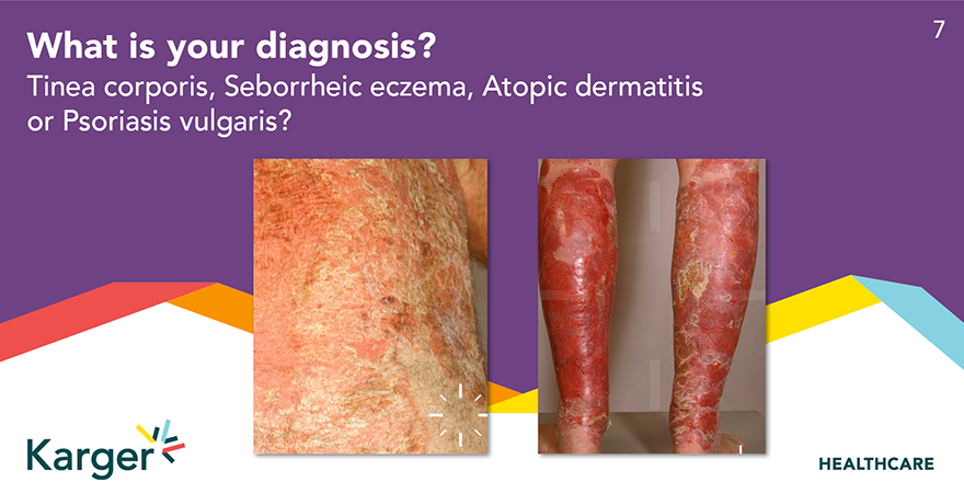 HealthKarger's tweet photo. Oh, this is clearly....something that #dermatologists recognize immediately. Write us the answer in the comments.
#DermaQuiz #KargerHCP https://t.co/vQbZdByFMS