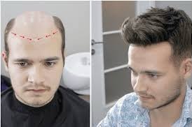HappyVannn's tweet photo. @GLupitaok @eeemiliano Exacto. Esto tiene es in peluca pegada no implante . Por eso no quería que le corten el pelo. Porque “no le crece más” . https://t.co/8aPnr2VyXg
