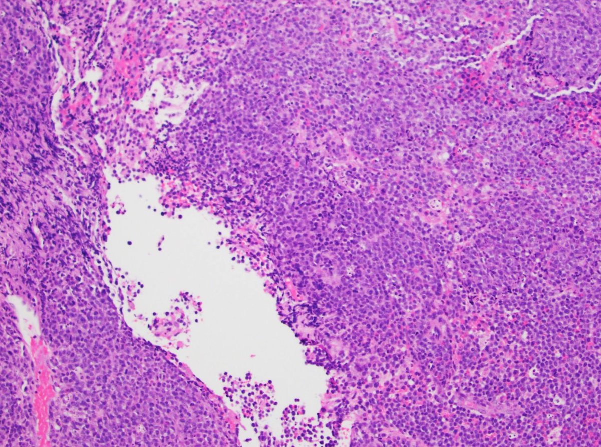 bitar_mireille's tweet photo. #brainmass; sheets of immature cells with high N/C ratio, frequent apoptosis; + lysosome, CD68, MPO, CD117, CD34; - CD3, CD20.
History of #MyelodysplasticSyndrome. Likely diagnosis? common mutations/ cytogenetic alterations?
#hemepath #neuropath #molecularpath #pathtwitter https://t.co/zHuKrO8hgm