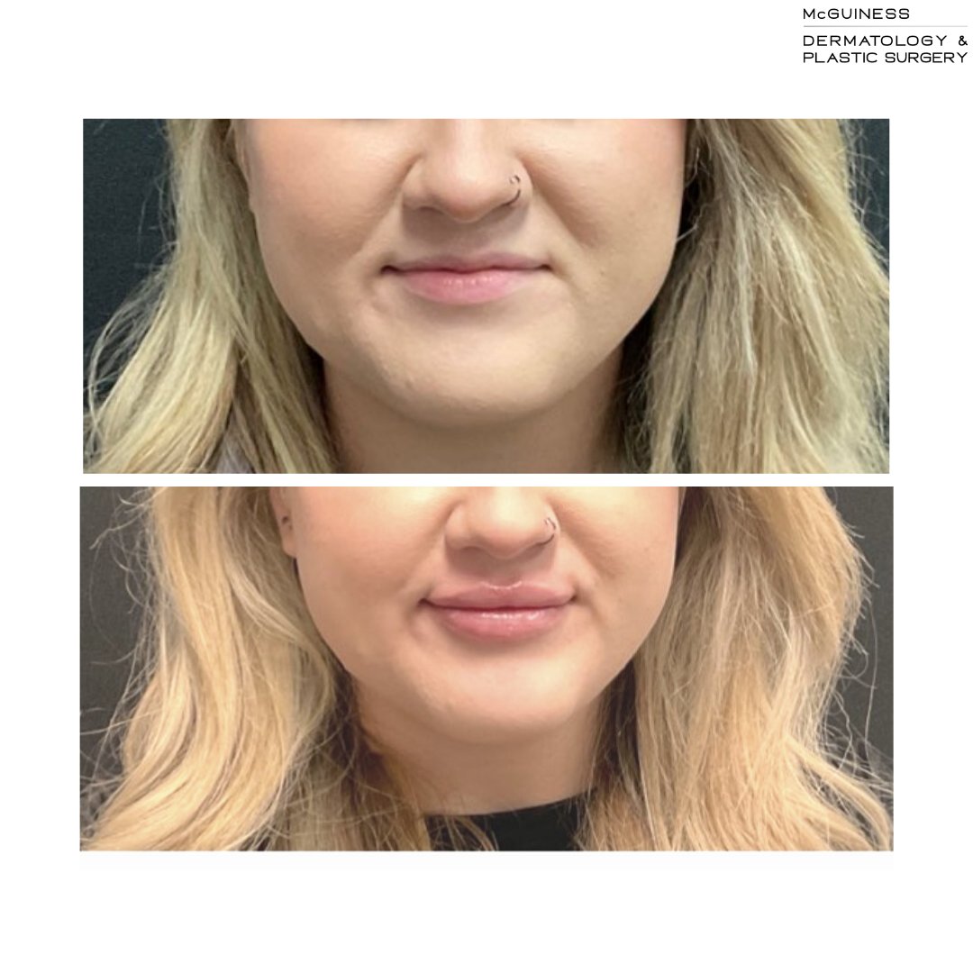 McGuinessDerm's tweet photo. This beautiful patient in her early 20’s came in wanting to enhance the natural shape of her lips. 

📍Done by Lana in Murphy 
💉 Product used: 1 Syringe of Volbella filler
📞 Call 972-316-4555 to make an appointment https://t.co/3VggNTd2GA
