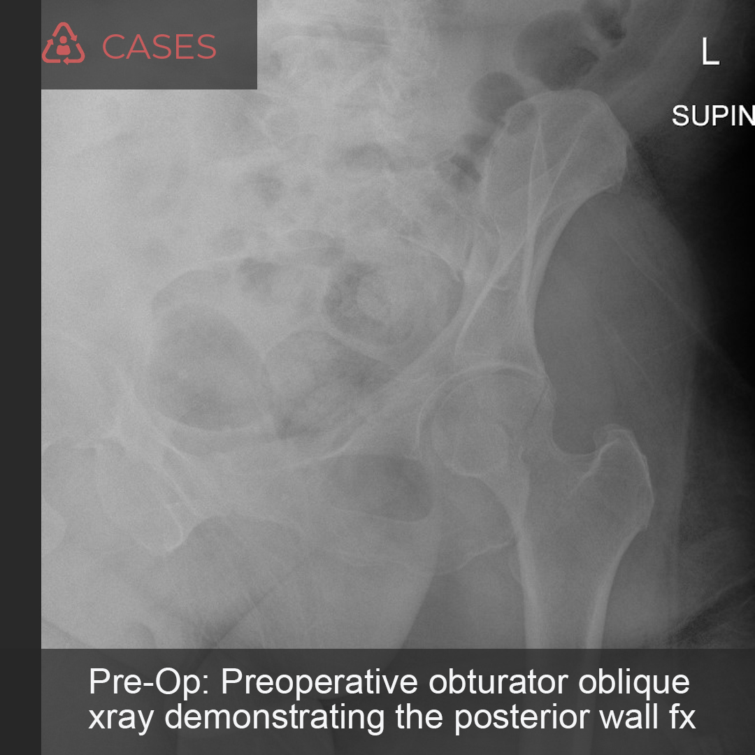 Here’s a new case by Dr. Eckhoff and Dr. Adler from <a href="/WBAMCArmyMed/">William Beaumont AMC</a> and <a href="/umcelpaso/">UMC El Paso</a>.

Hip Pain Following Polytrauma in 63F.

How would you manage this acetabular fx?

Click below for full case details.
orthobullets.tiny.us/3wfd2rpr

Share your insights with the #orthotwitter community!