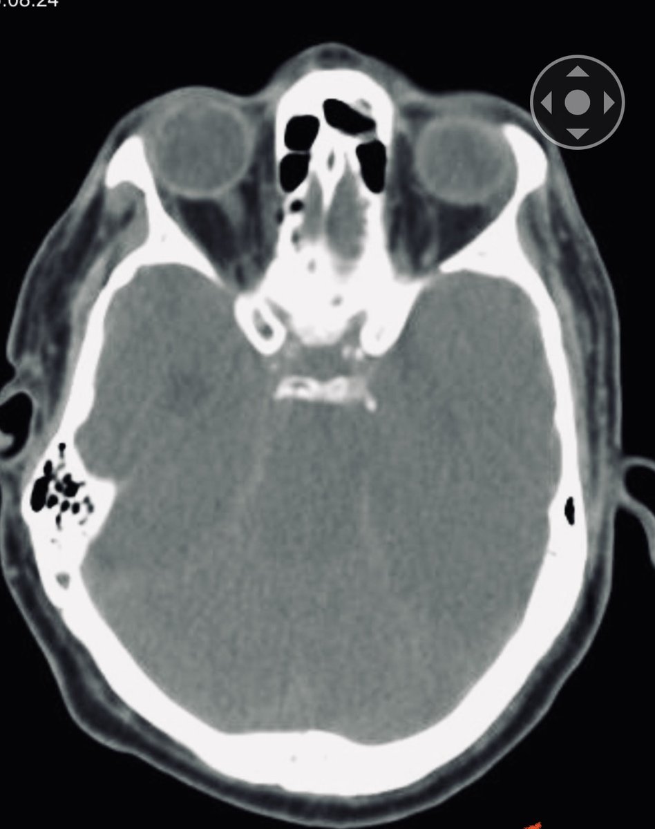 DannySilvaC1's tweet photo. 51 años HTA mal apego al tto.Hemorragia Interventricular >50%mortalidad > 70 % Hipertensiva #neurocritical #stroke #Hospitalclinicagye ⁦@jmjaureguiMD⁩ ⁦@JohnPeaMoran1⁩ ⁦@GabrielaSFM93⁩ ⁦@manuveli⁩ ⁦@mirellakbr⁩ https://t.co/Hde2pnIMCM