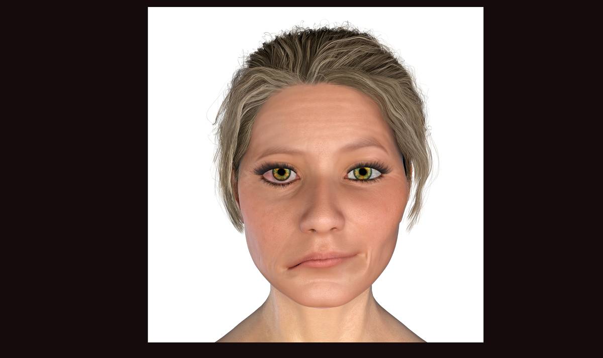 Baptist Health (@BaptistHealthSF) on Twitter photo 2022-06-28 16:41:40 When singer #JustinBieber said he has #RamsayHuntSyndrome, rare condition that has paralyzed half his face, the news raised questions about this rare disorder. And about its symptomatic similarity to Bell’s Palsy, a more common cause of facial paralysis. bit.ly/3bDimWh When singer #JustinBieber said he has #RamsayHuntSyndrome, rare condition that has paralyzed half his face, the news raised questions about this rare disorder. And about its symptomatic similarity to Bell’s Palsy, a more common cause of facial paralysis. bit.ly/3bDimWh