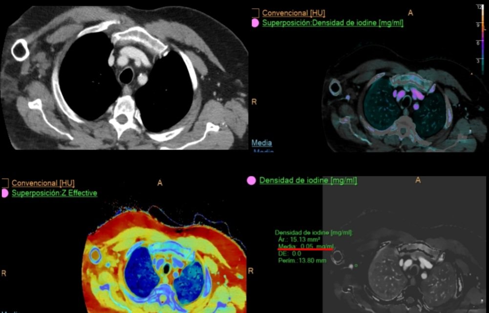 Although not needed for the dx, just for fun! #spectralCt

No enhancement was noted in this case. Remember, it is a non-neoplastic axonal and fibrous proliferation! Enhancement is variable and non specific in stump neuromas