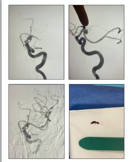PenNeuro's tweet image. US HCPs: #RED62 case by Dr. Stephen Grupke out of Covenant Medical Center in Lubbock, TX. #REDglideDifference Rx only. For risk info: bit.ly/37YcYIU Clinical results may vary.