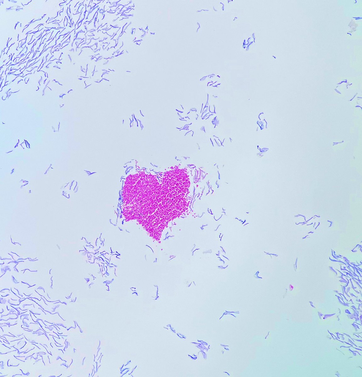 Sometimes I love a regular ol’ cyst, and sometimes they love me back 💜 #dermpath #cystlove #histology