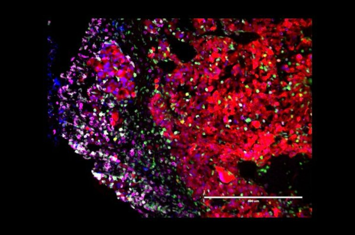 Working to train the brain’s immune system to recognize and kill #glioblastoma and #brainmetastases. Photo credit to <a href="/ARodrigues121/">Adrian Rodrigues, MD</a> and collaboration credit to the <a href="/WernigLab/">Marius Wernig</a>. #GephartLab #CIM22
