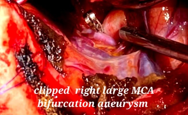 Increase in the number of prompt presentation while help in reducing mortality rate in LMICs