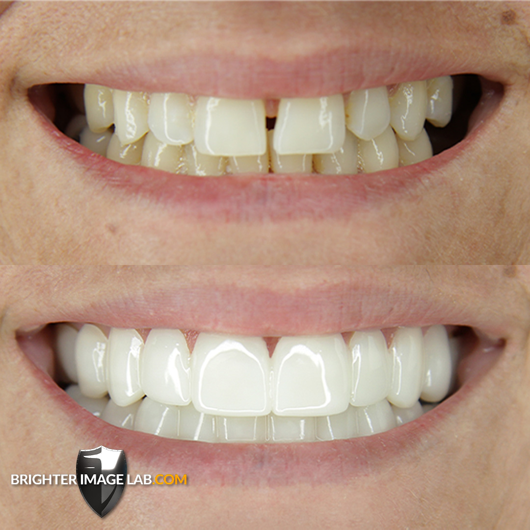 brighterimage01's tweet photo. Extremely proud of this smile makeover, the work we do just gets better and better!
#bilveneer #presson #snaponsmile #brighterimagelab #baresults #aligners #crookedteeth #teethwhitening #whiteteeth #nodentist #smilemakeover #newsmile https://t.co/1YNPXHzMYT