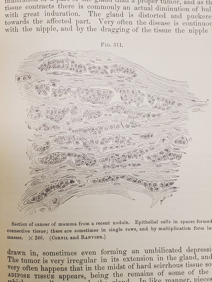 JacobRitter2's tweet photo. I thought it would be fun to post some pictures from "A Manual of Pathology" by Joseph Coats, MD, published in 1883. #PathTwitter #PathUpdates1883 https://t.co/15pkuijJFN