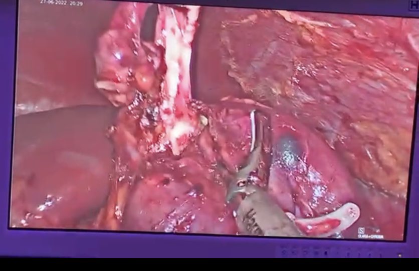 Nefrectomia polar superior laparoscopica. 13 años,ureter ectopico.