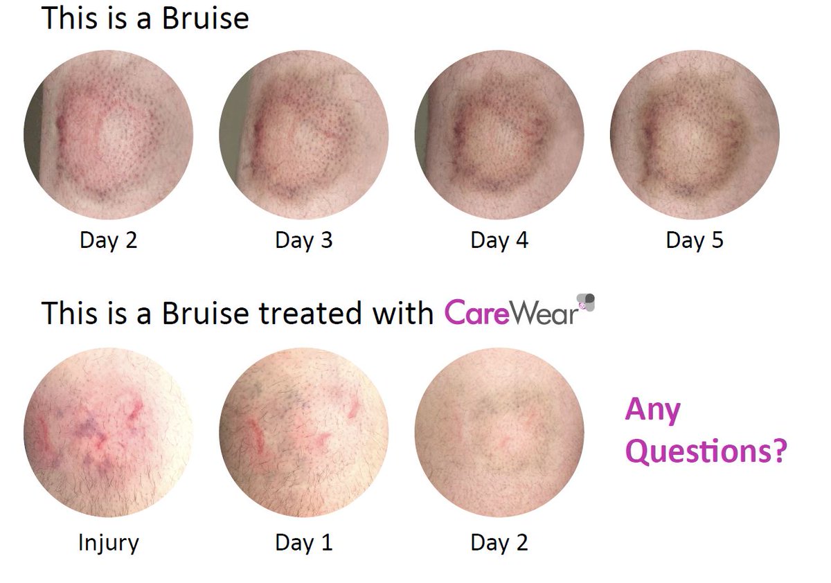 We are at #nata2022 this week to present our research on #photobiomodulation Therapy for Thigh Contusion &amp; Soft Tissue Injury .

Come by the Free Comm Orals: Therapeutic Interventions on June 30th at 10:56am (PCC, 204B) visit us at booth #2601 to learn more.