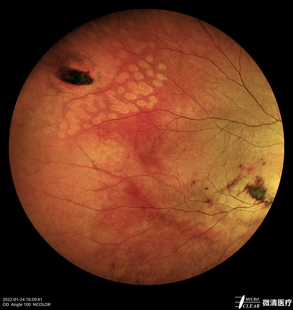 Post Surgery #Retinalhole
Pictured by Apollo the #confocalretinalophthalmoscope
#retinopathy #angiography #autofluorescence #icga #fluoresceinangiography #funduscamera #ophthalmology #ophthalmic