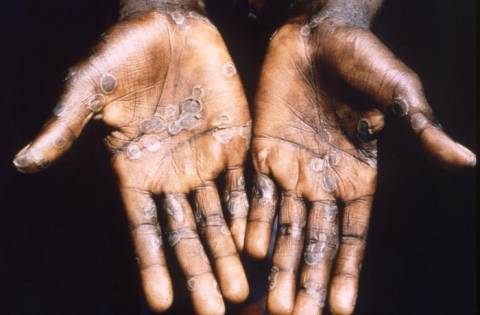 SaharaReporters's tweet photo. Nigerian Agency, NCDC Puts Citizens On Alert As Monkeypox Infections Rise To Over 250 Cases | Sahara Reporters https://t.co/sXkk9MsX8C https://t.co/4t42y15lhL