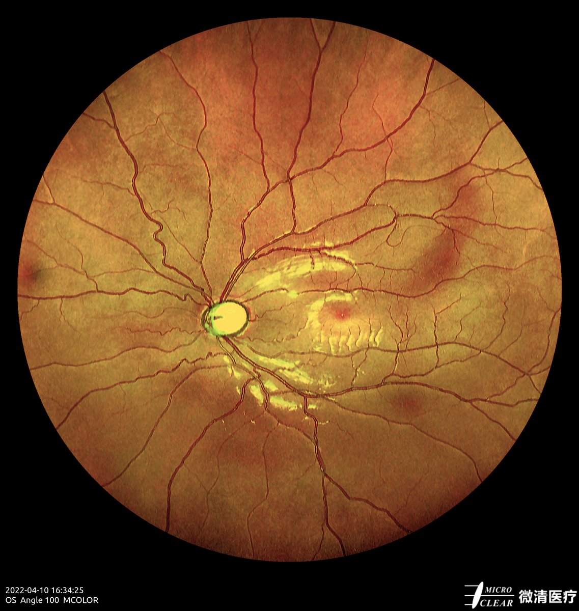 Microcleartec's tweet photo. #Glaucoma Picured by Microclear Medical Apollo, the #ConfocalRetinalOphthalmoscope at @Zhejiang Provincial People's Hospital
#retinopathy #funduscamera #ophthalmic https://t.co/kFaB2EGxDN