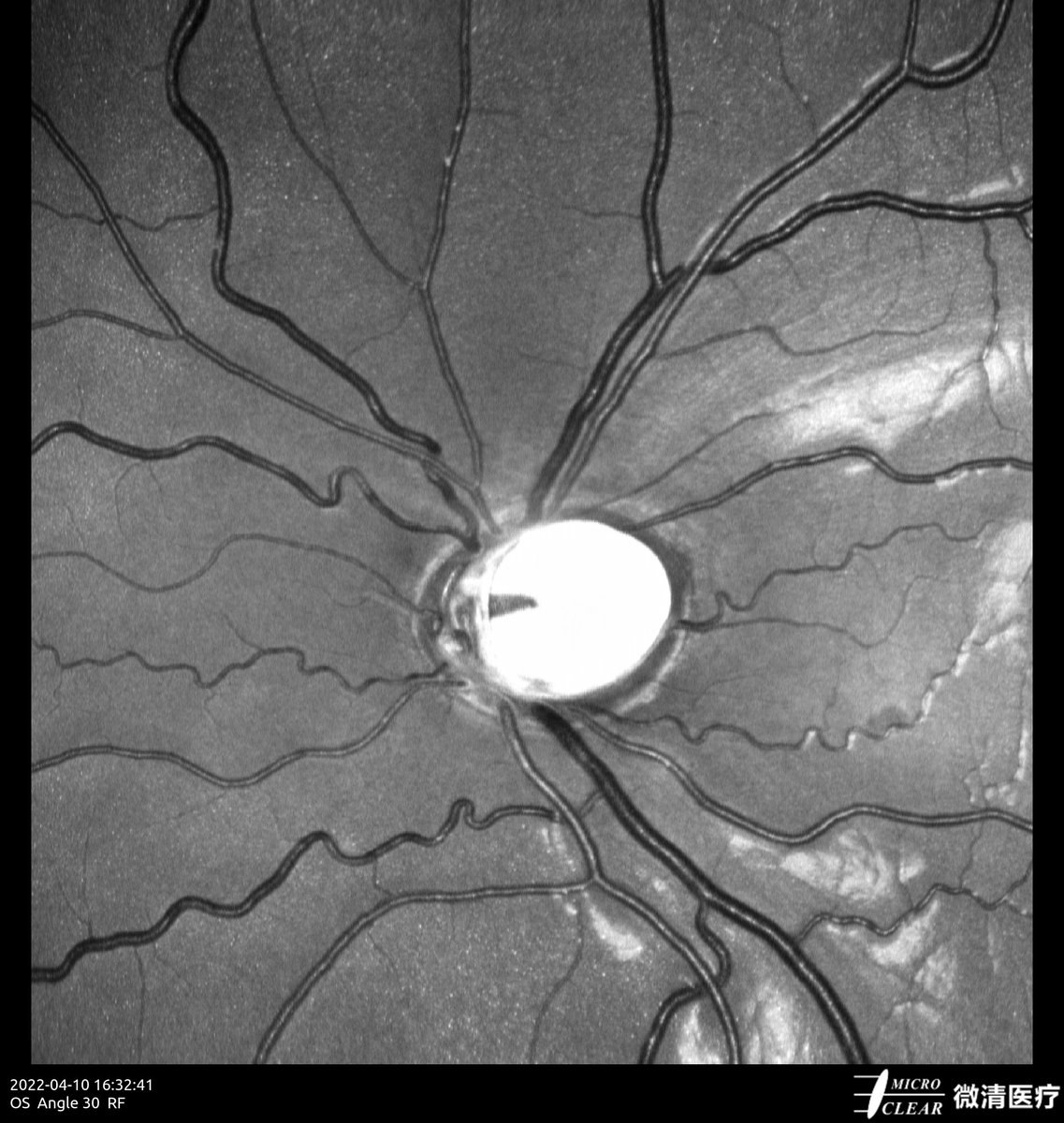 #Glaucoma Picured by Microclear Medical Apollo, the #ConfocalRetinalOphthalmoscope at <a href="/Zhejiang/">浙江新闻</a> Provincial People's Hospital
#retinopathy #funduscamera #ophthalmic