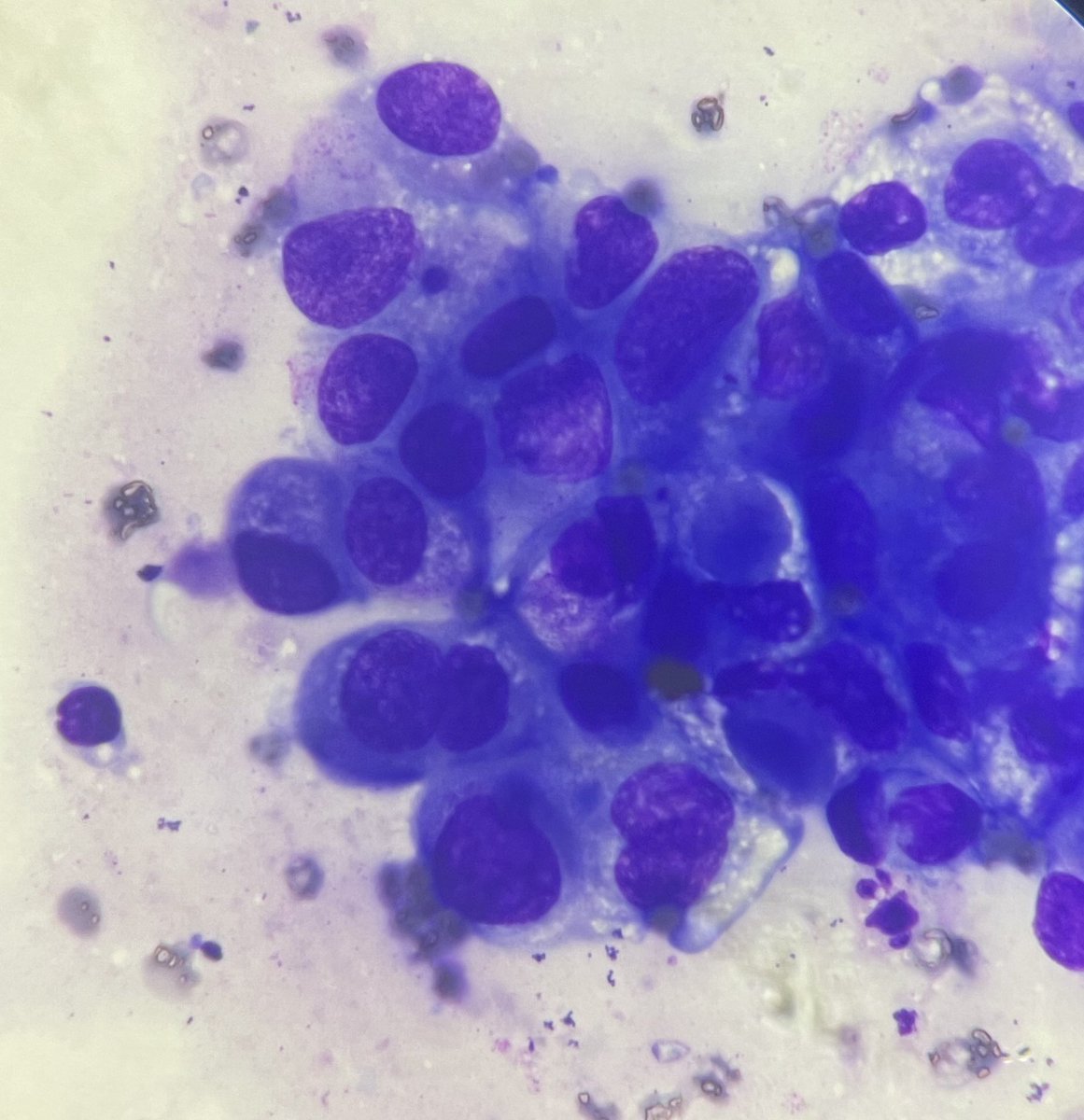 50 year female, c/o bloody nipple discharge .

#imprintsmearcytology #cytology  #PathTwitter