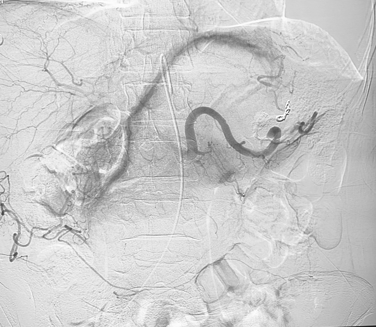 Dr Ajit Yadav (@drajityadav) on Twitter photo Embolization Tweetorial # 6
Case of splenic artery aneurysm ( Ruptured)
Large Hematoma in lesser sac
Coil plus Glue Embolization done
Distal Coil then glue is cost effective and ideal agent .
<a href="/thegestgroup/">GEST -Global Embolization Symposium & Technologies</a> <a href="/No_cut_surgery/">IIR IRad indore</a> @IR_juniors <a href="/SIRRFS/">SIR RFS</a> <a href="/RajNarayanan67/">Raj Narayanan</a> <a href="/ISVIRIndia/">ISVIR India</a> Embolization Tweetorial # 6
Case of splenic artery aneurysm ( Ruptured)
Large Hematoma in lesser sac
Coil plus Glue Embolization done
Distal Coil then glue is cost effective and ideal agent .
<a href="/thegestgroup/">GEST -Global Embolization Symposium & Technologies</a> <a href="/No_cut_surgery/">IIR IRad indore</a> @IR_juniors <a href="/SIRRFS/">SIR RFS</a> <a href="/RajNarayanan67/">Raj Narayanan</a> <a href="/ISVIRIndia/">ISVIR India</a>